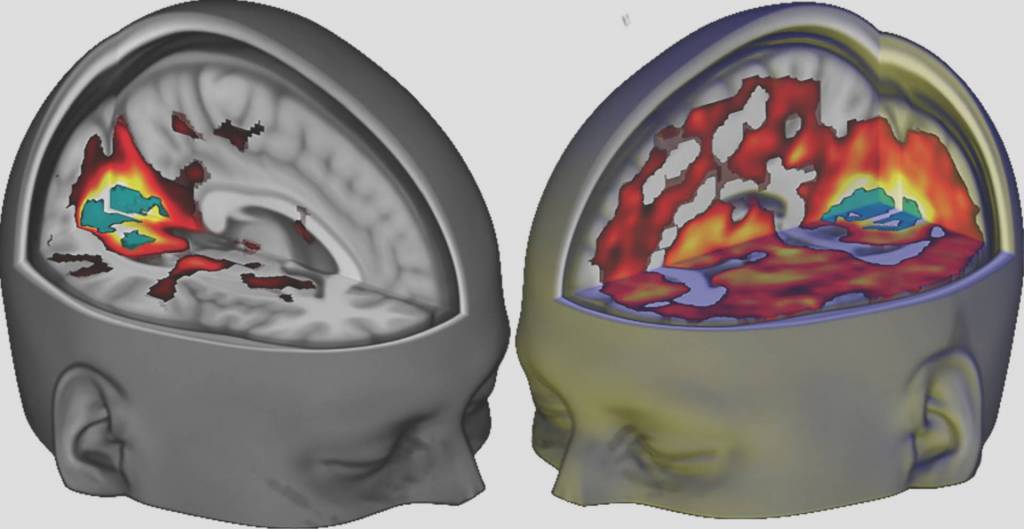 Natalie Jonk Case Study LSD the Brain